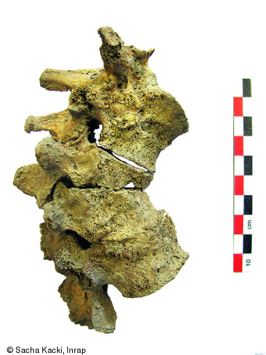 Lésion vertébrale tuberculeuse chez un sujet adulte (XIe-XIIe s.) du cimetière médiéval d'Allonnes (Eure-et-Loir), 2009.La destruction de la majeure partie du corps de la 11e vertèbre thoracique a conduit à une gibbosité rachidienne.